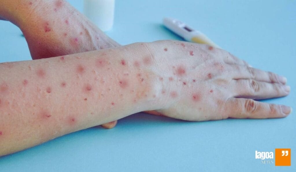 Como Prevenir a Mpox: Proteja-se Dessa Nova Doença em Lagoa Santa