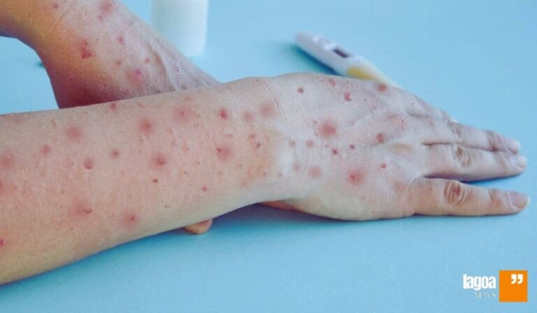 Como Prevenir a Mpox: Proteja-se Dessa Nova Doença em Lagoa Santa