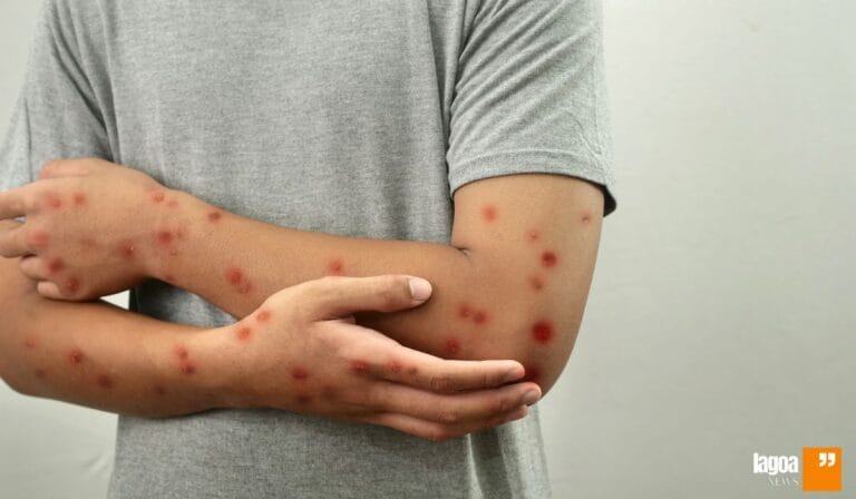 Primeiro caso de Mpox em Lagoa Santa: alerta de saúde, medidas preventivas