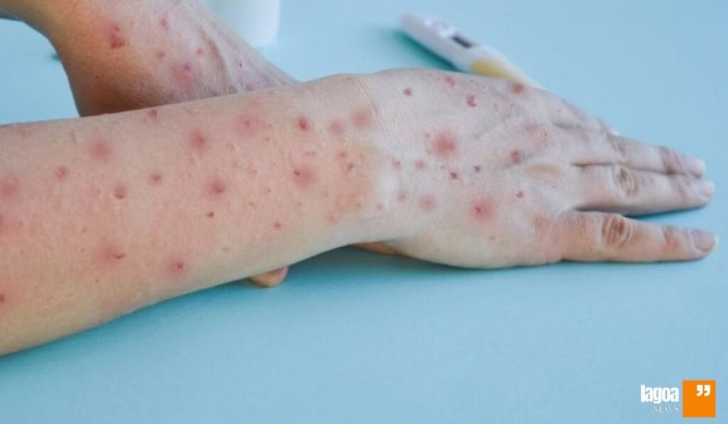 Primeiro caso de Mpox em Lagoa Santa: alerta de saúde, medidas preventivas 2 Primeiro caso de Mpox em Lagoa Santa - alerta